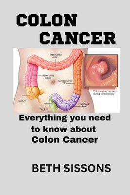 Colon Cancer Symptoms Stages Treatment