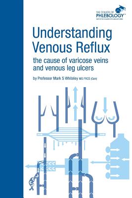 Understanding Venous Reflux the Cause of Varicose Veins and Venous Leg Ulcers: Varicose veins and venous leg ulcers (College of Phlebology) Cover Image