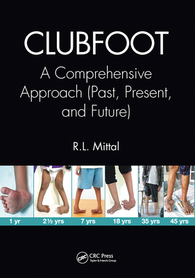 Clubfoot: A Comprehensive Approach (Past, Present, and Future) Cover Image