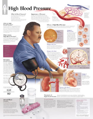 High Blood Pressure Chart: Laminated Wall Chart Cover Image
