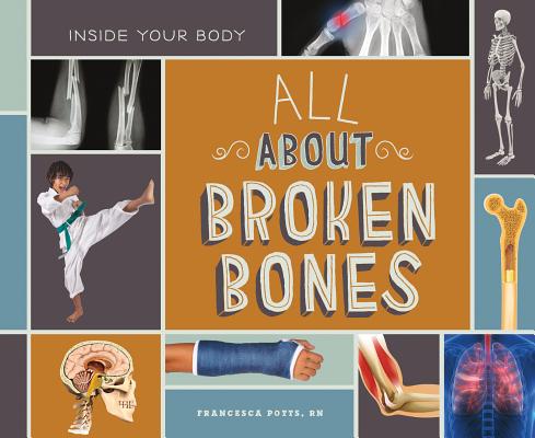 All about Broken Bones (Inside Your Body)