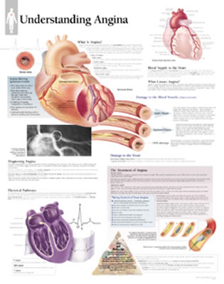 Understanding Angina Chart: Wall Chart Cover Image