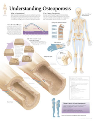 Understanding Osteoporosis Chart: Wall Chart Cover Image