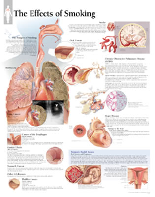 Effects of Smoking Chart: Laminated Wall Chart Cover Image