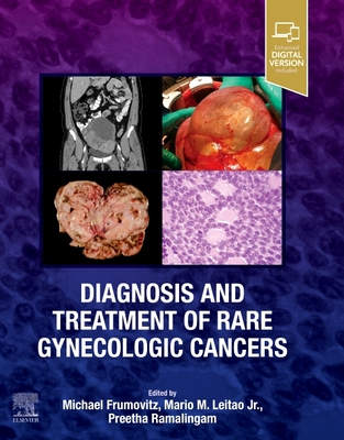 Diagnosis and Treatment of Rare Gynecologic Cancers Cover Image