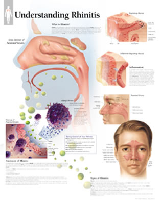 Understanding Rhinitis Chart: Wall Chart Cover Image