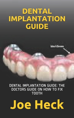 Dental Implantation Guide: Dental Implantation Guide: The Doctors Guide on How to Fix Tooth By Joe Heck Cover Image