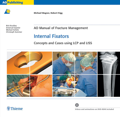 Ao Manual of Fracture Management: Internal Fixators: Concepts and