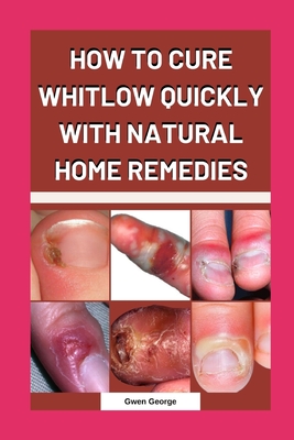 How to Cure Whitlow Quickly with Natural Home Remedies By Gwen George Cover Image