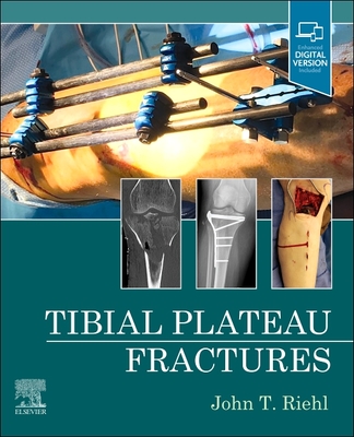 Tibial Plateau Fractures Cover Image