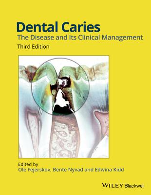 Dental Caries, Third Edition Cover Image