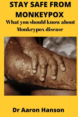 Stay Safe from Monkeypox: What You Should Know About Monkeypox Disease