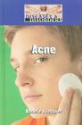 Acne (Diseases & Disorders) By Bonnie Juettner Cover Image