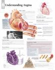 Understanding Angina Chart: Wall Chart Cover Image