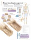 Understanding Osteoporosis Chart: Wall Chart Cover Image