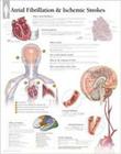 Atrial Fib & Ischemic Strokes Wall Chart (Anatomical Wall Charts) By Various Cover Image