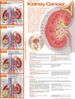Understanding Kidney Cancer Anatomical Chart Cover Image