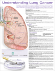 Understanding Lung Cancer Anatomical Chart By Anatomical Chart Company (Prepared for publication by) Cover Image