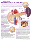 Understanding Pancreatic Cancer Anatomical Chart By Anatomical Chart Company		 (Prepared for publication by) Cover Image