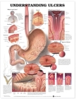 Understanding Ulcers Anatomical Chart Cover Image