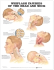 Whiplash Injuries of the Head and Neck Anatomical Chart By Anatomical Chart Company (Prepared for publication by) Cover Image